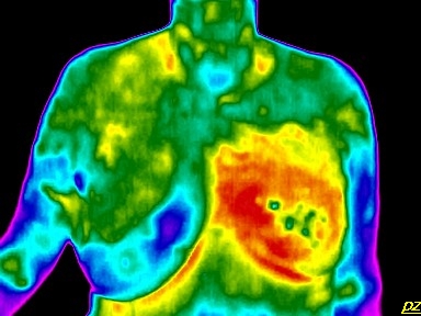  Test – hőenergia felvétel: Bal oldali mellrák sugárkezelés után 