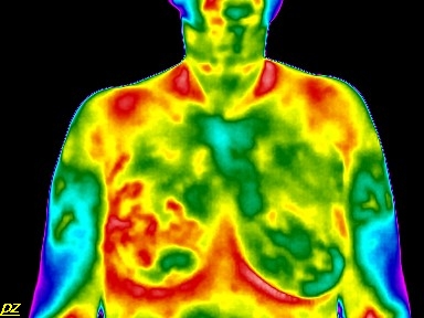 Test – hőenergia felvétel: jobb oldali mellrák 