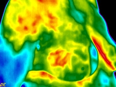 Test - hőenergia felvétel: kezdődő időskori mellrák