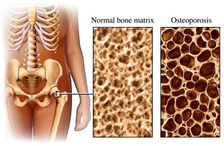 Osteoporosis