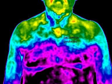  Pajzsmirigy-gyulladás ( test – hőenergia felvétel ) 