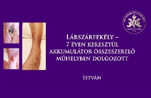 Lábszárfekély - 7 éven keresztül akkumulátor összeszerelő műhelyben dolgozott